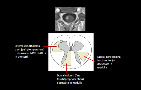 Spinal Cord Lesions