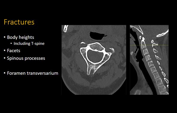 Cervical Spine CT Search Pattern